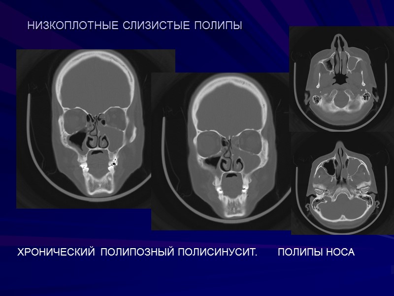 НИЗКОПЛОТНЫЕ СЛИЗИСТЫЕ ПОЛИПЫ  ХРОНИЧЕСКИЙ  ПОЛИПОЗНЫЙ ПОЛИСИНУСИТ.      